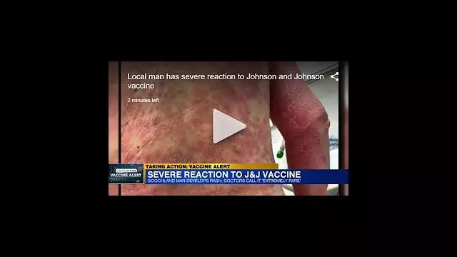 Man has severe reaction to Johnson and Johnson vax VCU doctors believe it was direct result of shot(כתוביות אוטו)
